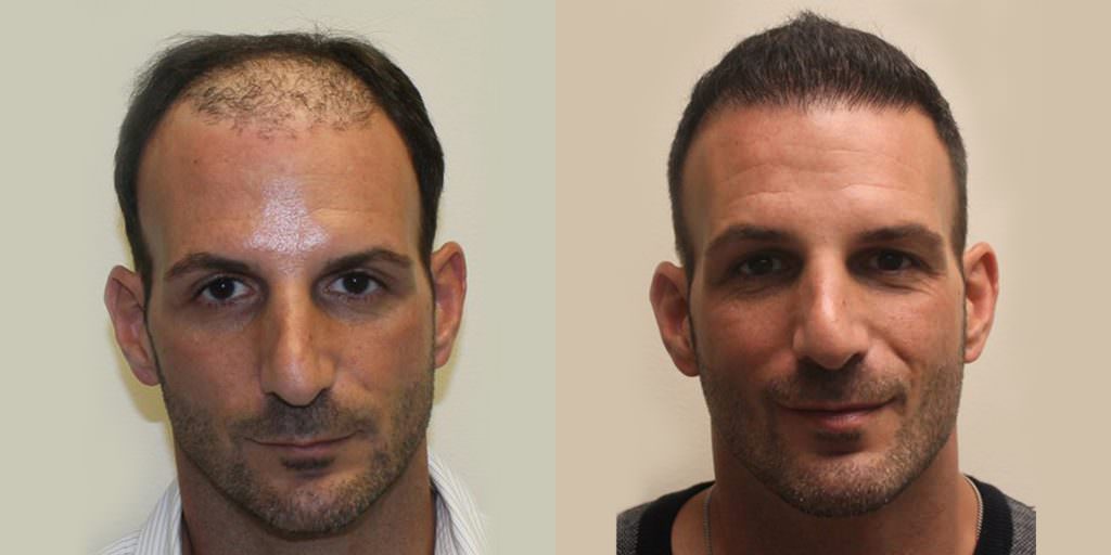 Extreme Hair Loss Is Not The Only Option Before And Afters Crown Hairline 