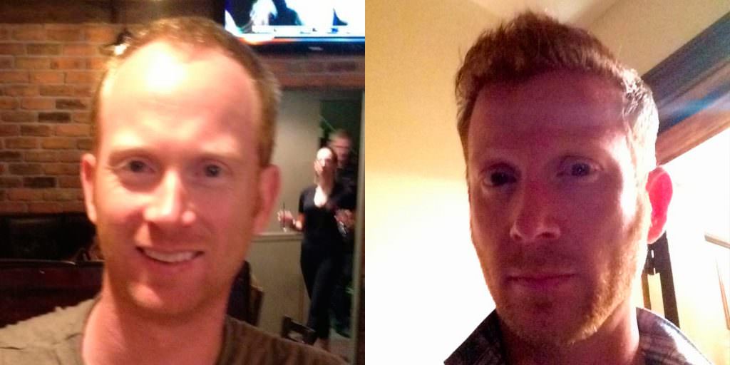 Dr. Bolton Keeps It Coming - Another Hair Transplant Success Story Before And Afters Hairline 