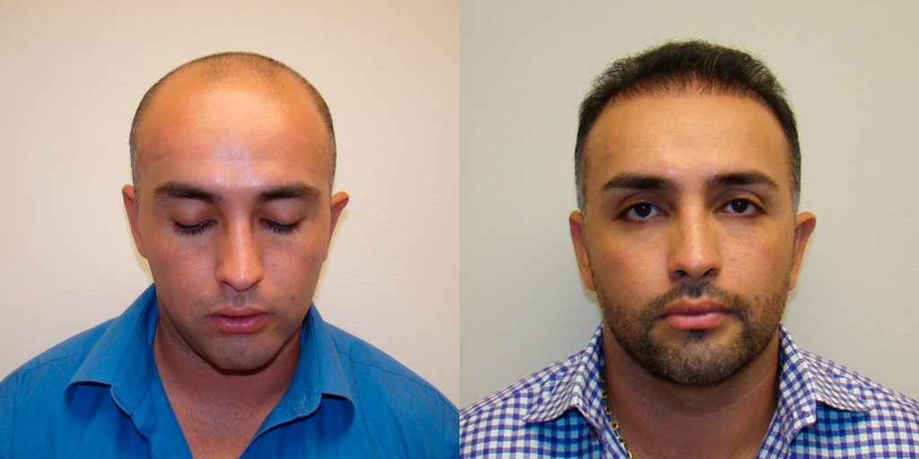 Reverse Hair Loss With A Customized Hair Transplant Before And Afters Difficult Cases Hairline 