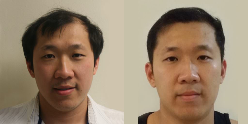 Napalese Patient's MaxHarvest Plus™ Hair Transplant Results At Halfway Point Before And Afters Crown Difficult Cases Hairline Healing/Growth Process MaxHarvest Plus™ Procedures 