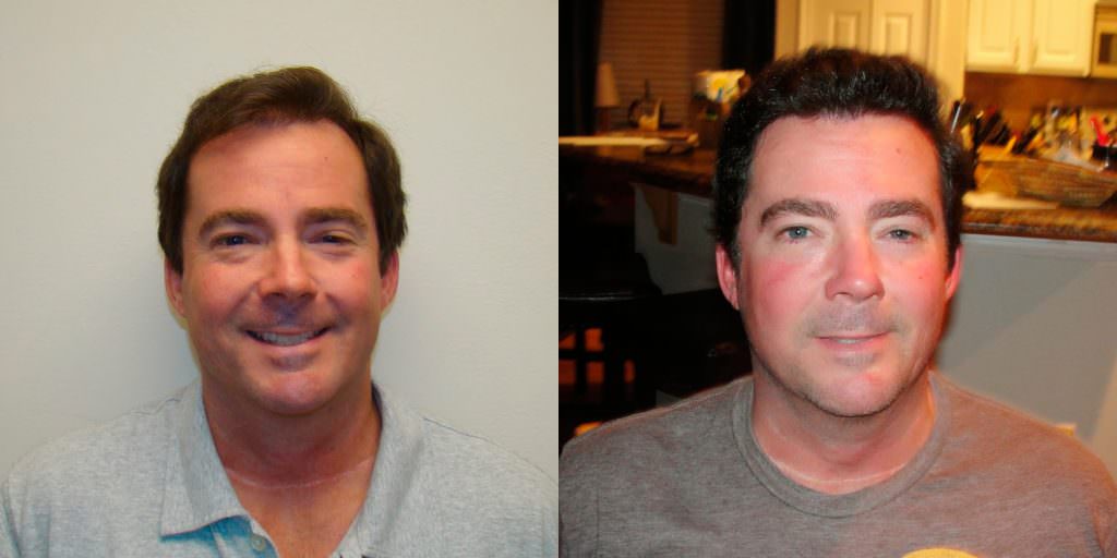 From Thin To Thick Hair In 1 Hair Transplant Before And Afters Crown Hairline 