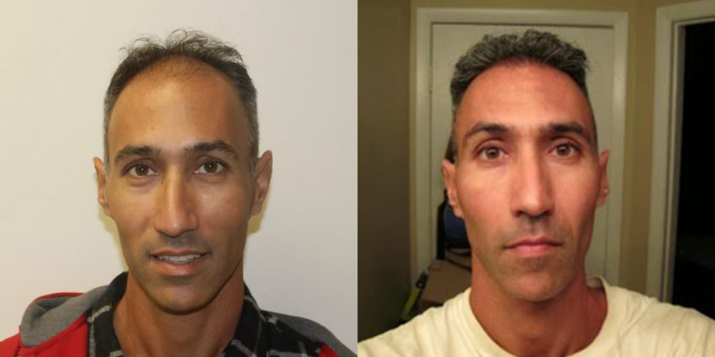 Incredible Results With No Trace Of A Hair Transplant Before And Afters Crown Difficult Cases Hairline 