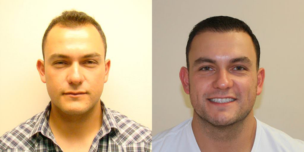 Worried About A Scar After A Hair Transplant? Before And Afters Hairline Suture Line/Scar 