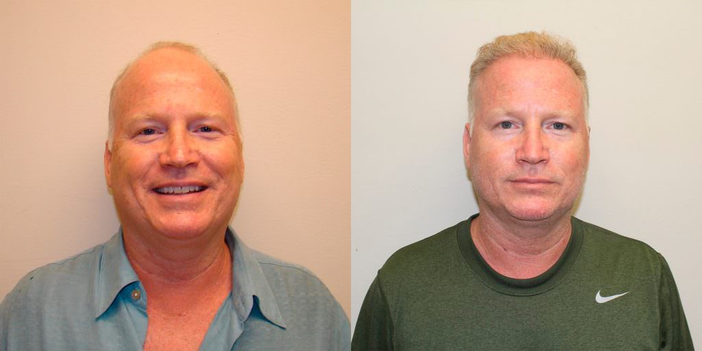 Complete Hair Loss Transformation After Just 1 MaxHarvest Plus™ Procedure Before And Afters Crown Difficult Cases Hairline Healing/Growth Process MaxHarvest Plus™ Procedures 