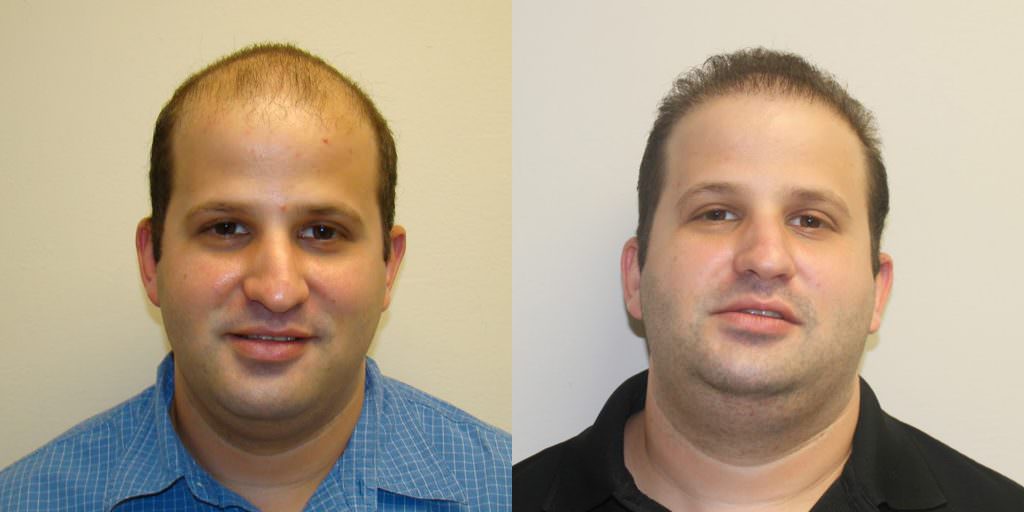 Completely Bald Patient Dramatically Changes His Appearance Before And Afters Difficult Cases