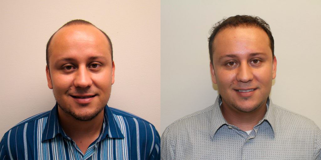 Another Great Hair Transplant Result To Fix Premature Balding Before And Afters Hairline 