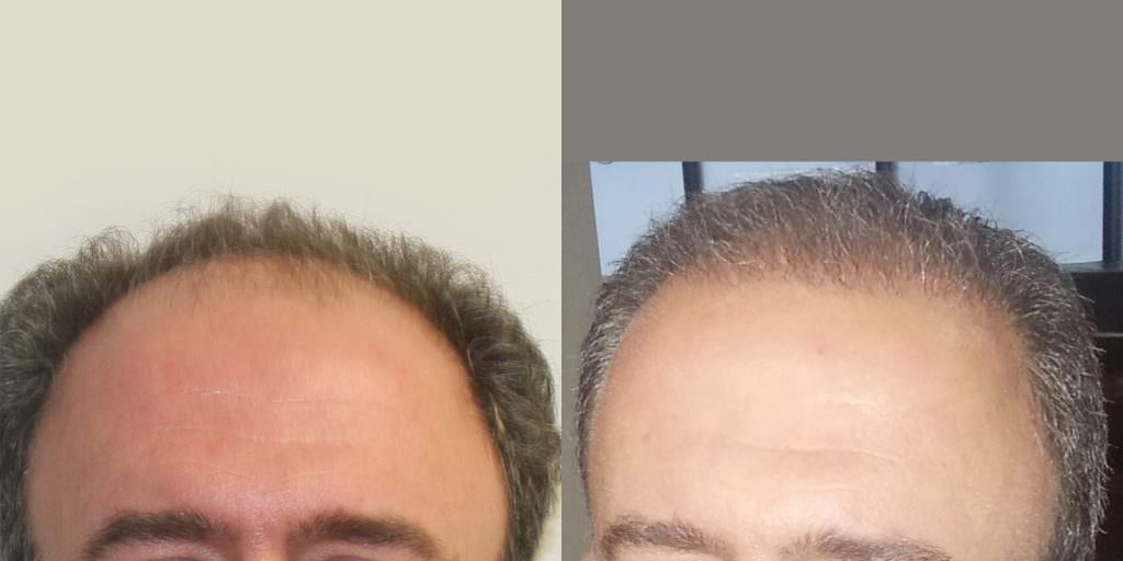 Another Hairline Success Case Before And Afters Hairline Healing/Growth Process 