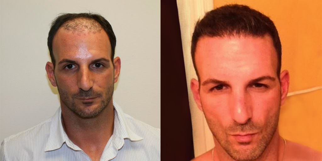 Extreme Hair Loss Is Not The Only Option Before And Afters Crown Hairline 