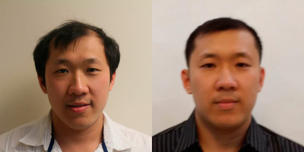 Napalese Patient's MaxHarvest Plus™ Hair Transplant Results At Halfway Point Before And Afters Crown Difficult Cases Hairline Healing/Growth Process MaxHarvest Plus™ Procedures 