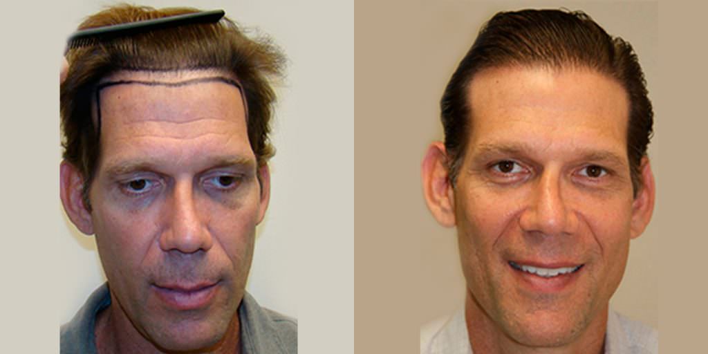 Dr. Bolton's Own Patient Advisor Gets A MaxHarvest™ Hair Transplant Before And Afters Hairline Healing/Growth Process Testimonials 