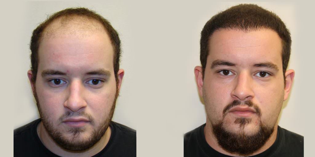 19 Year Old's Completely Restored Look After Hair Transplant Before And Afters Crown Difficult Cases Hairline Testimonials 