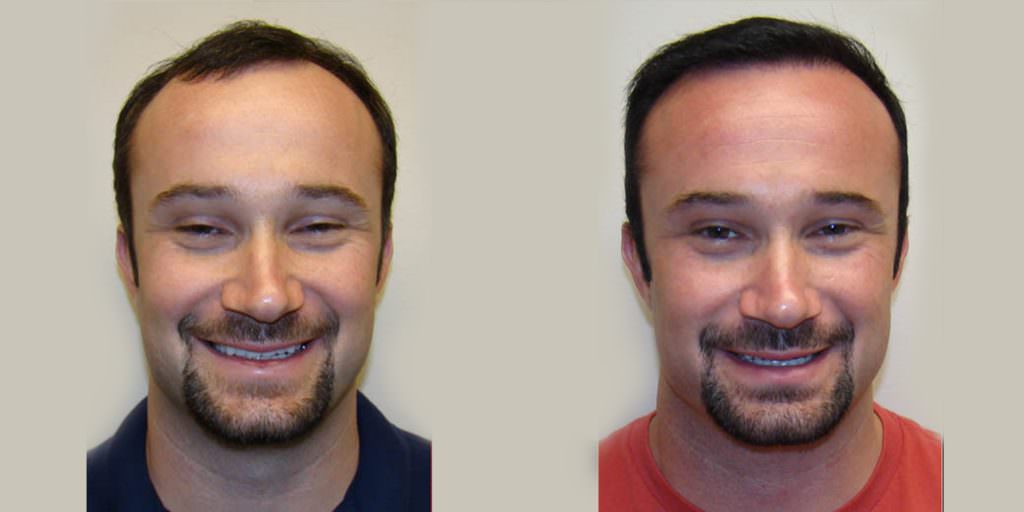 How To Reverse Balding In One MaxHarvest™ Procedure Before And Afters Hairline Testimonials 