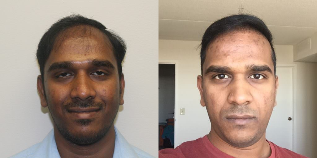 Legitimate Hair Transplant Results Are A Call Away Before And Afters Hairline 