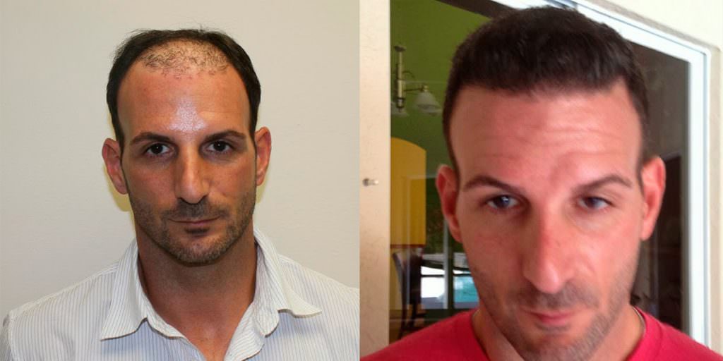 Extreme Hair Loss Is Not The Only Option Before And Afters Crown Hairline 