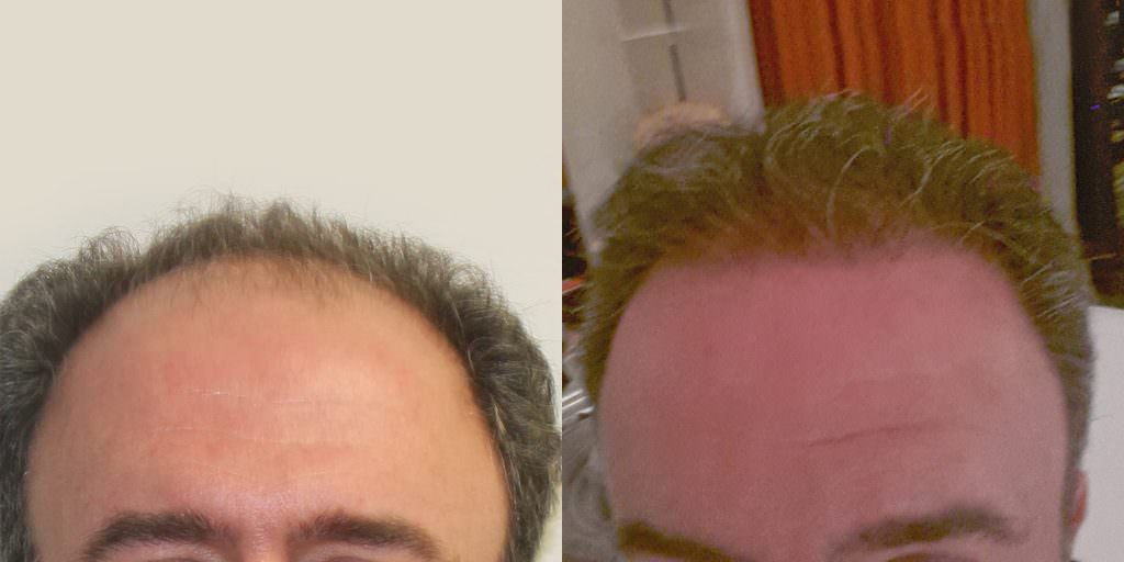 Another Hairline Success Case Before And Afters Hairline Healing/Growth Process 