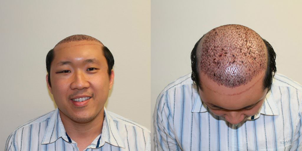 Napalese Patient's MaxHarvest Plus™ Hair Transplant Results At Halfway Point Before And Afters Crown Difficult Cases Hairline Healing/Growth Process MaxHarvest Plus™ Procedures 