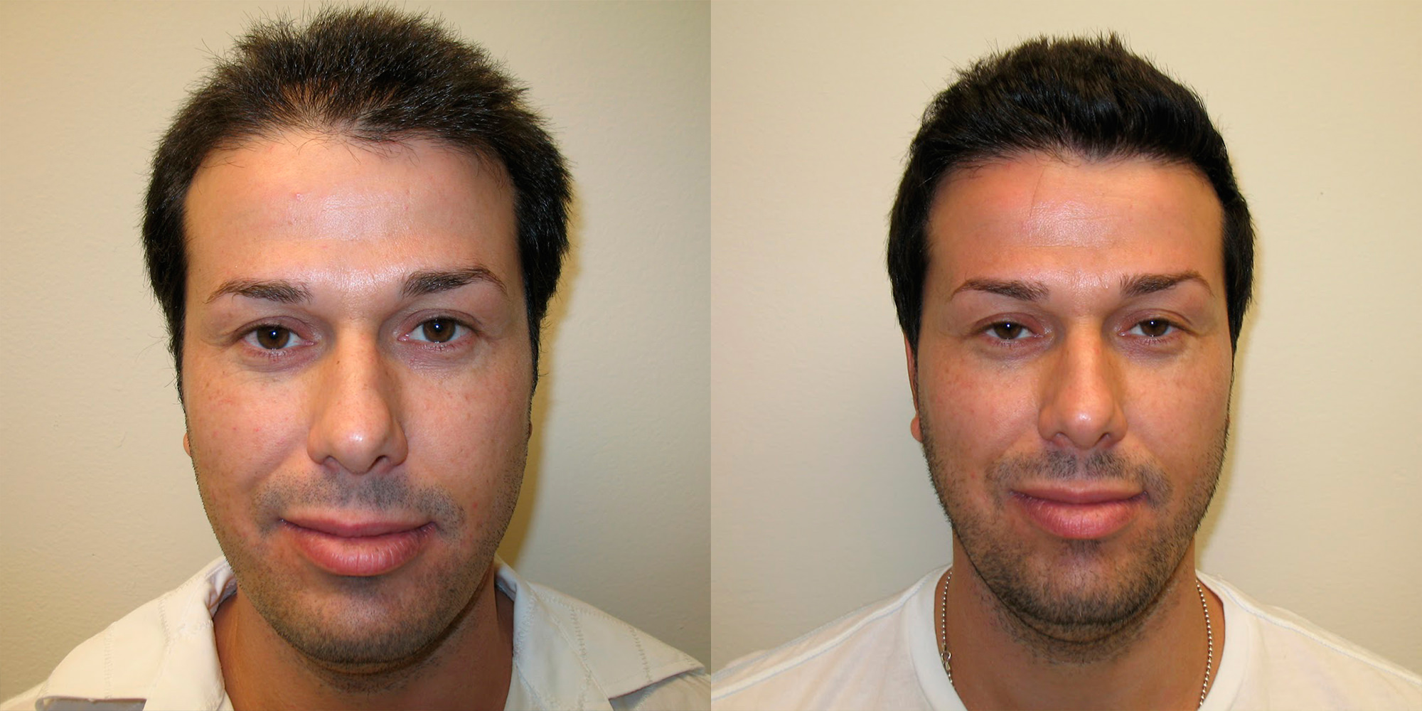 5 Years After Hair Transplant Follow-Up.