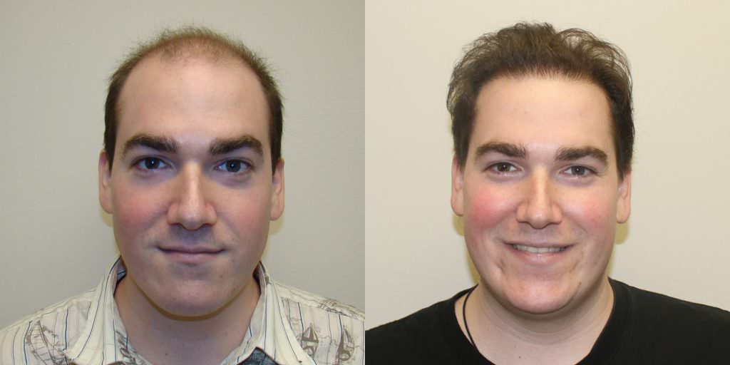 1 Hair Transplant, 10 Years Younger Before And Afters Difficult Cases Hairline 