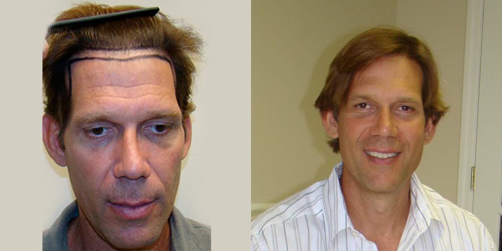 Dr. Bolton's Own Patient Advisor Gets A MaxHarvest™ Hair Transplant Before And Afters Hairline Healing/Growth Process Testimonials 