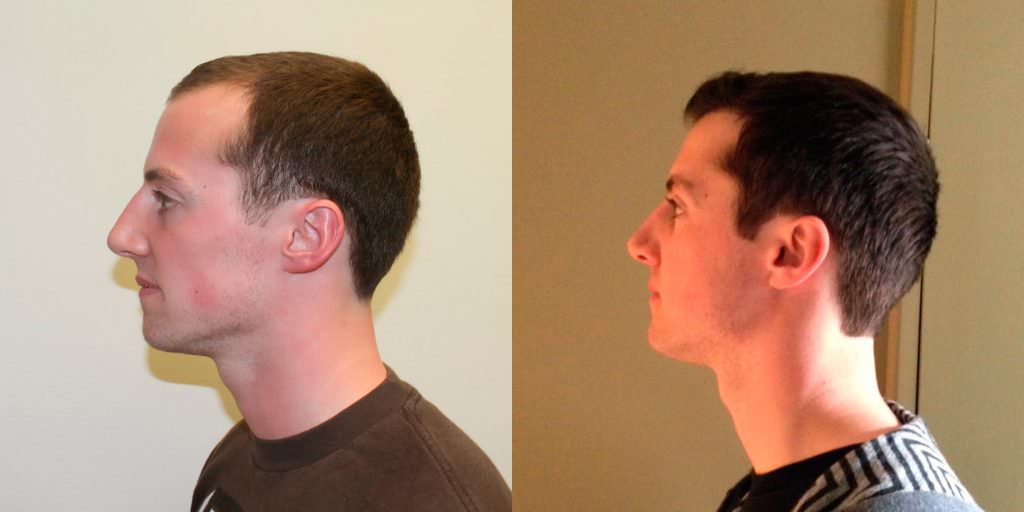 Young Man Flies In From California To Have A MaxHarvest™ Hair Transplant Before And Afters Hairline 