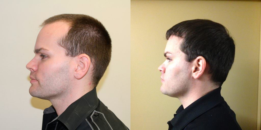 Premature Hair Loss Correction Before And Afters Crown Hairline Healing/Growth Process 