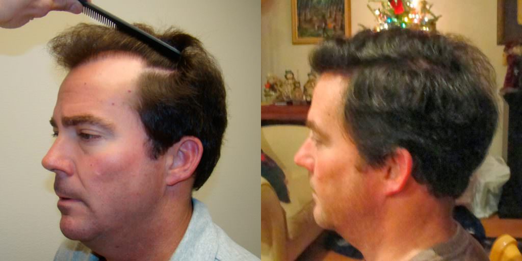 From Thin To Thick Hair In 1 Hair Transplant Before And Afters Crown Hairline 