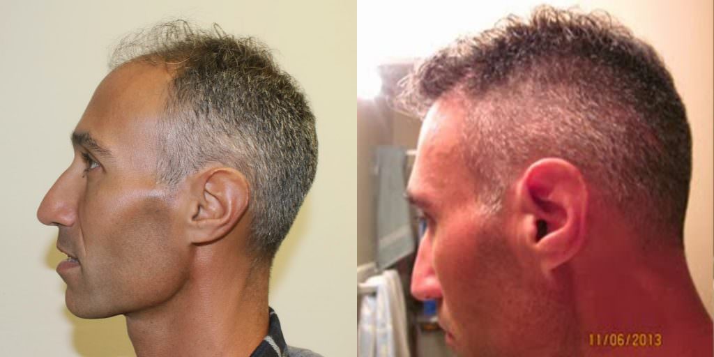 Incredible Results With No Trace Of A Hair Transplant Before And Afters Crown Difficult Cases Hairline 