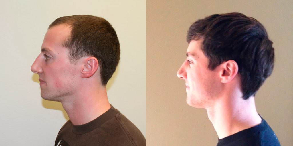 Young Man Flies In From California To Have A MaxHarvest™ Hair Transplant Before And Afters Hairline 