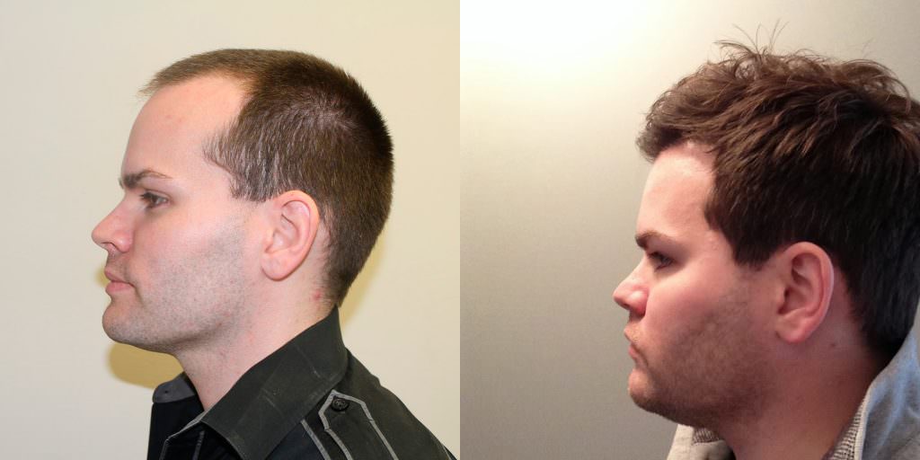 Premature Hair Loss Correction Before And Afters Crown Hairline Healing/Growth Process 