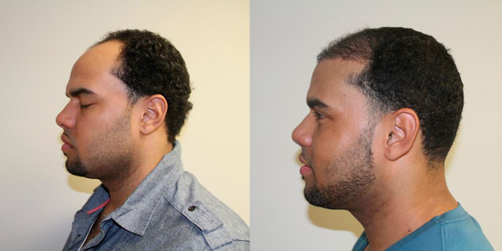 5 Month Complete Hairline Restoration Results Before And Afters Hairline Healing/Growth Process Suture Line/Scar 