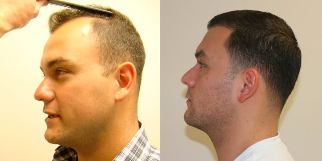 Worried About A Scar After A Hair Transplant? Before And Afters Hairline Suture Line/Scar 