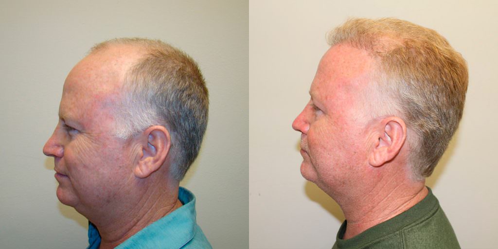 Complete Hair Loss Transformation After Just 1 MaxHarvest Plus™ Procedure Before And Afters Crown Difficult Cases Hairline Healing/Growth Process MaxHarvest Plus™ Procedures