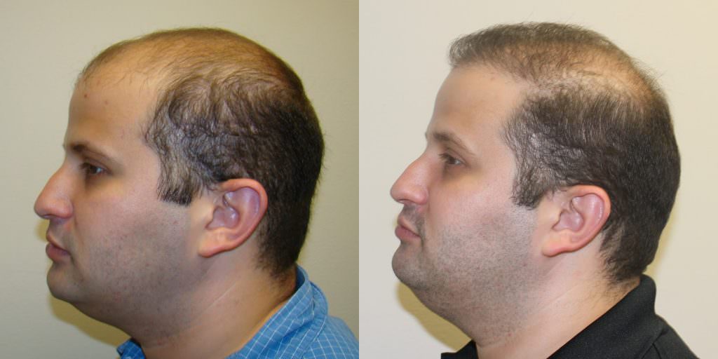 Completely Bald Patient Dramatically Changes His Appearance Before And Afters Difficult Cases
