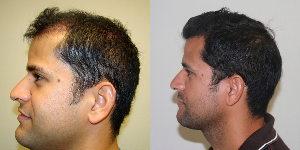 Full And Thick Density, 1 Procedure Hair Transplant Result Before And Afters Crown Healing/Growth Process 