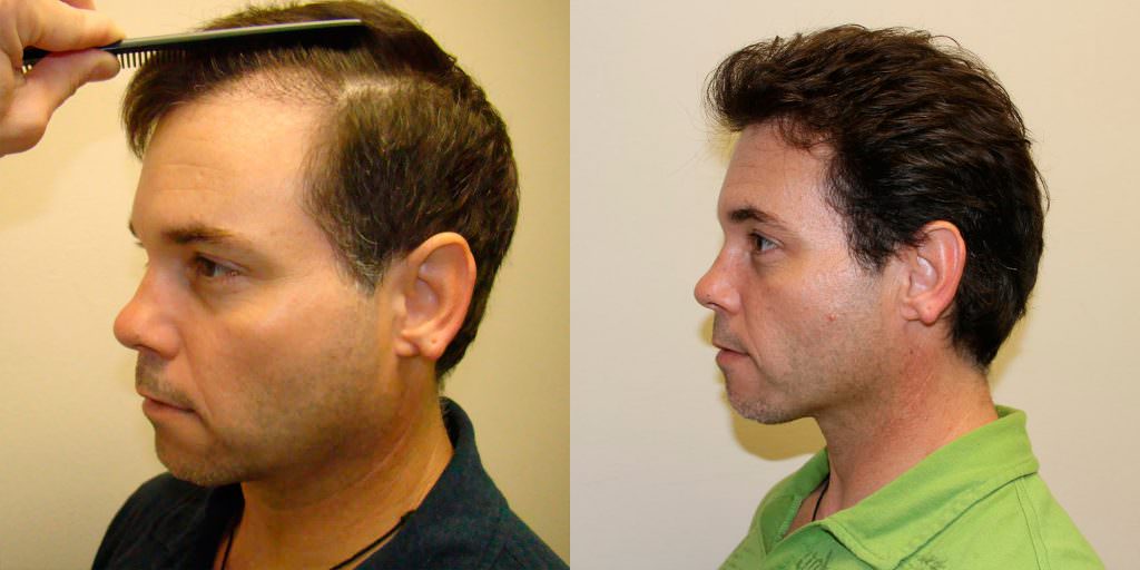 Actor Wants To Stabilize Hair Loss And Improve His Appearance With A Proven Hair Transplant Method Before And Afters 