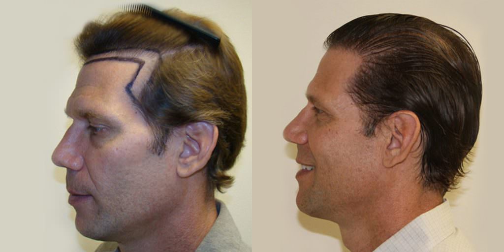 Dr. Bolton's Own Patient Advisor Gets A MaxHarvest™ Hair Transplant Before And Afters Hairline Healing/Growth Process Testimonials 
