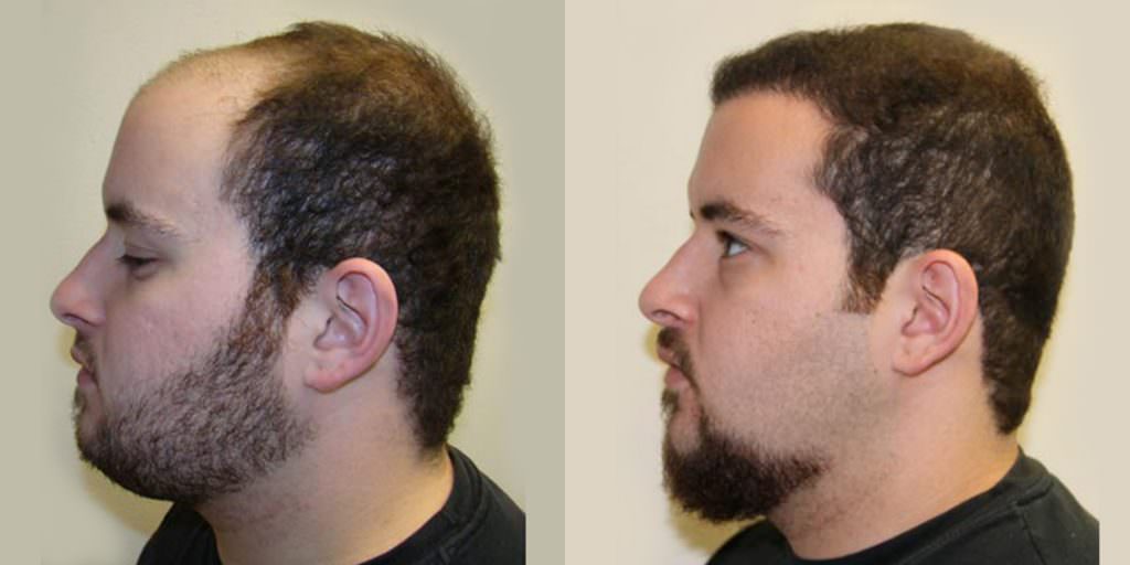 19 Year Old's Completely Restored Look After Hair Transplant Before And Afters Crown Difficult Cases Hairline Testimonials 