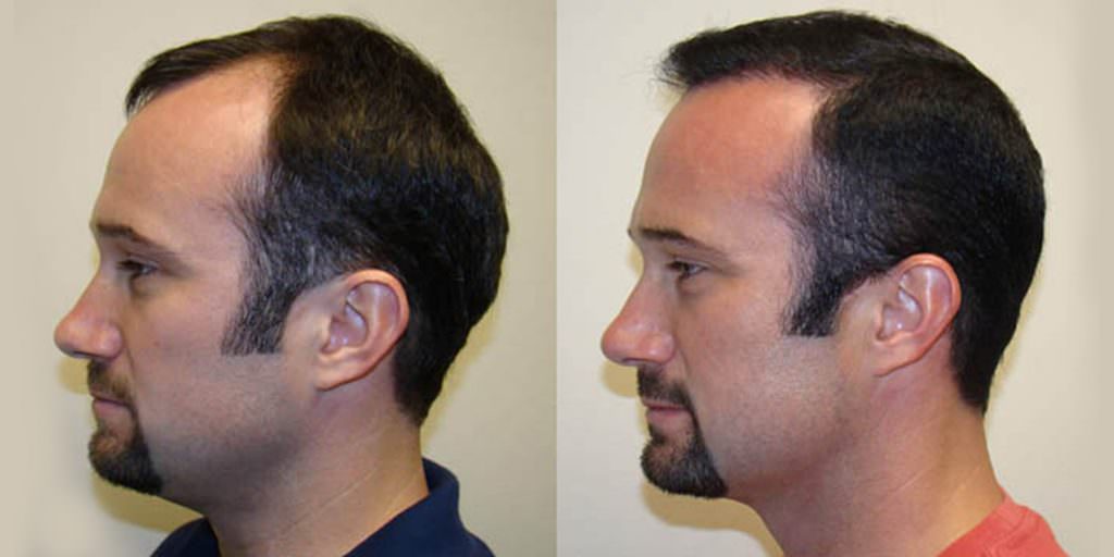 How To Reverse Balding In One MaxHarvest™ Procedure Before And Afters Hairline Testimonials 