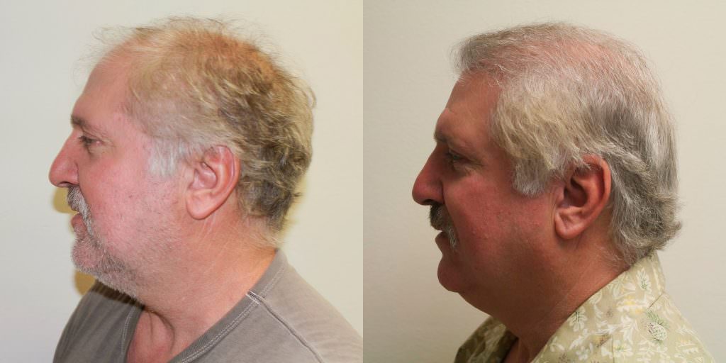 Hair Transplant Before And After Importance Before And Afters Crown Difficult Cases Healing/Growth Process 