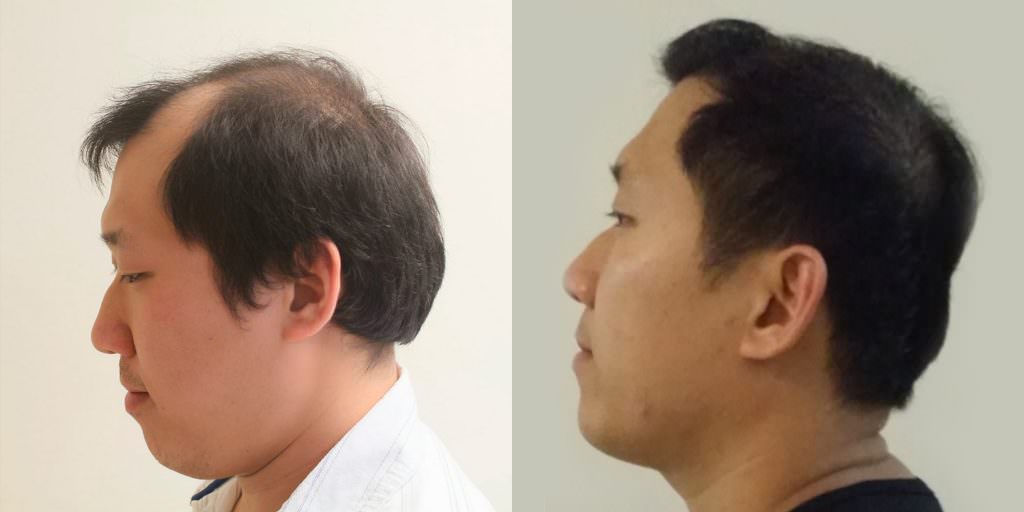 Napalese Patient's MaxHarvest Plus™ Hair Transplant Results At Halfway Point Before And Afters Crown Difficult Cases Hairline Healing/Growth Process MaxHarvest Plus™ Procedures 