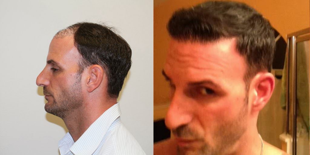 Extreme Hair Loss Is Not The Only Option Before And Afters Crown Hairline 