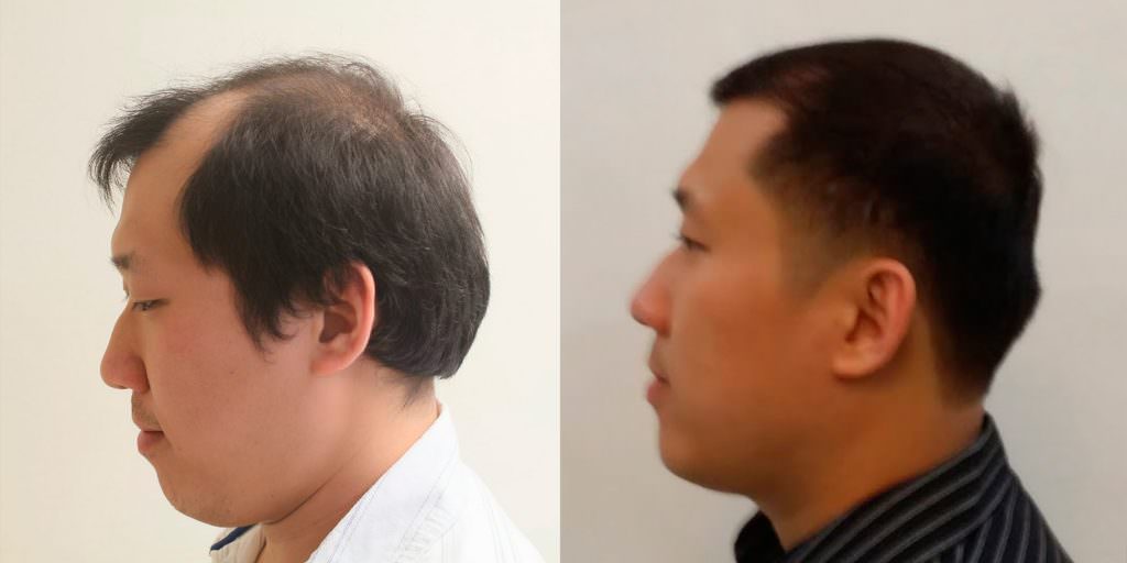 Napalese Patient's MaxHarvest Plus™ Hair Transplant Results At Halfway Point Before And Afters Crown Difficult Cases Hairline Healing/Growth Process MaxHarvest Plus™ Procedures 