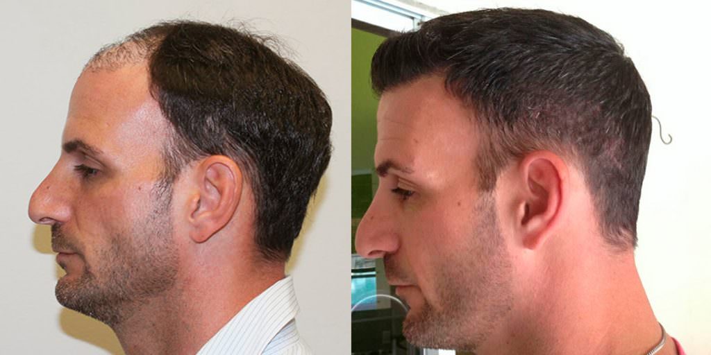 Extreme Hair Loss Is Not The Only Option Before And Afters Crown Hairline