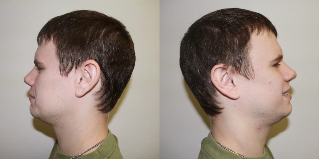 Corrective Hair Restoration With Previous Scar Removal Before And Afters Hairline Healing/Growth Process Suture Line/Scar 