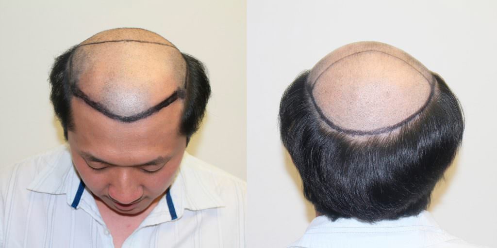 Napalese Patient's MaxHarvest Plus™ Hair Transplant Results At Halfway Point Before And Afters Crown Difficult Cases Hairline Healing/Growth Process MaxHarvest Plus™ Procedures 