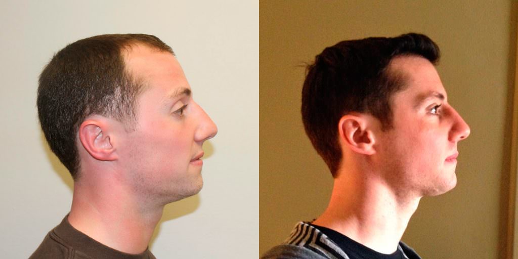 Young Man Flies In From California To Have A MaxHarvest™ Hair Transplant Before And Afters Hairline 