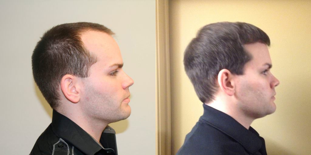 Premature Hair Loss Correction Before And Afters Crown Hairline Healing/Growth Process 