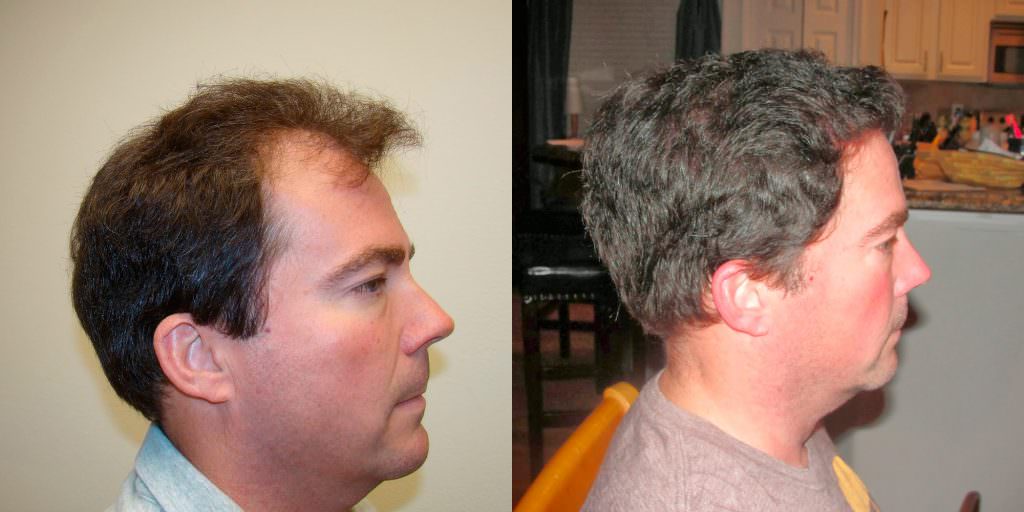 From Thin To Thick Hair In 1 Hair Transplant Before And Afters Crown Hairline 