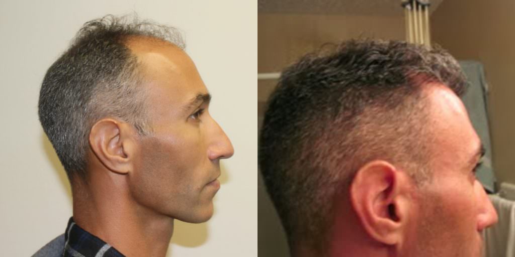 Incredible Results With No Trace Of A Hair Transplant Before And Afters Crown Difficult Cases Hairline