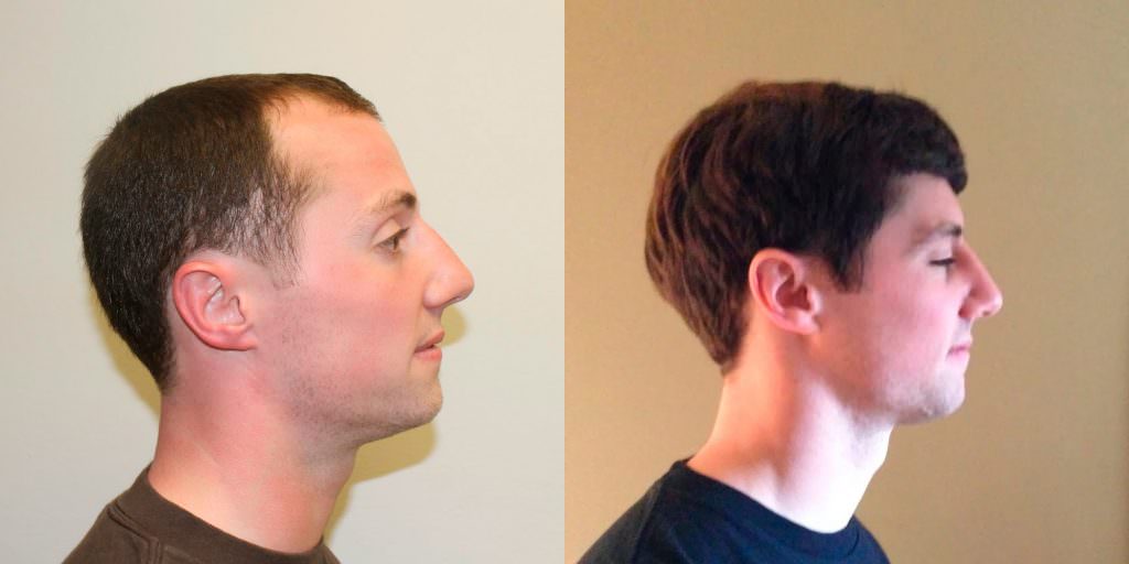 Young Man Flies In From California To Have A MaxHarvest™ Hair Transplant Before And Afters Hairline